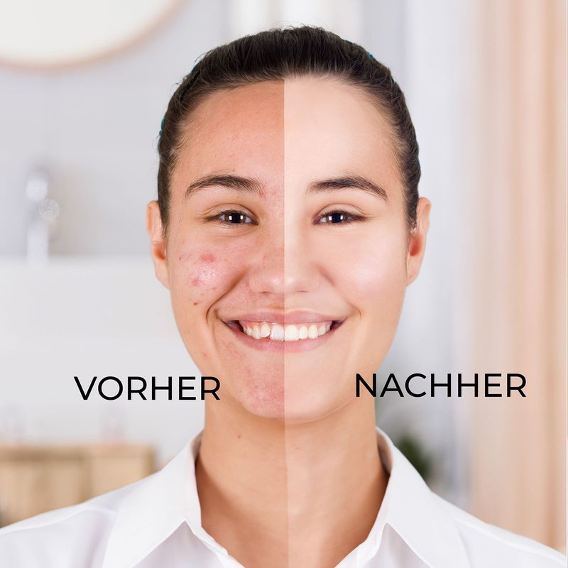 Mitesserentferner Gesichtspflege-Set Akne-Set Pflege-Set Beauty-Set